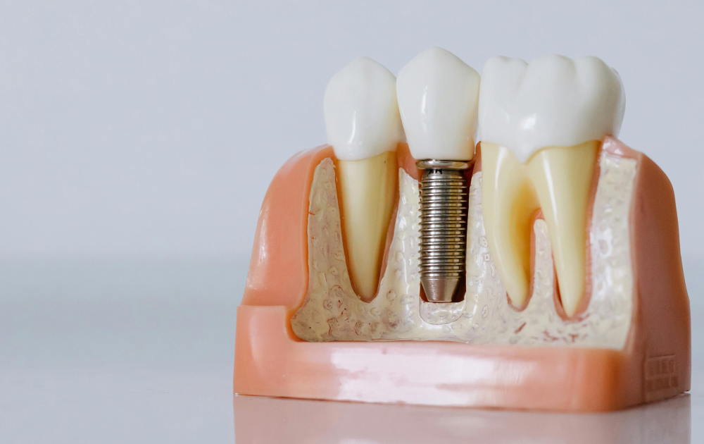 Dental Implant